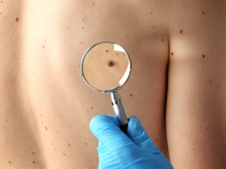 clinica de cirurgia plastica em santos dra ana lucia lemos manchas ou pinta na pele